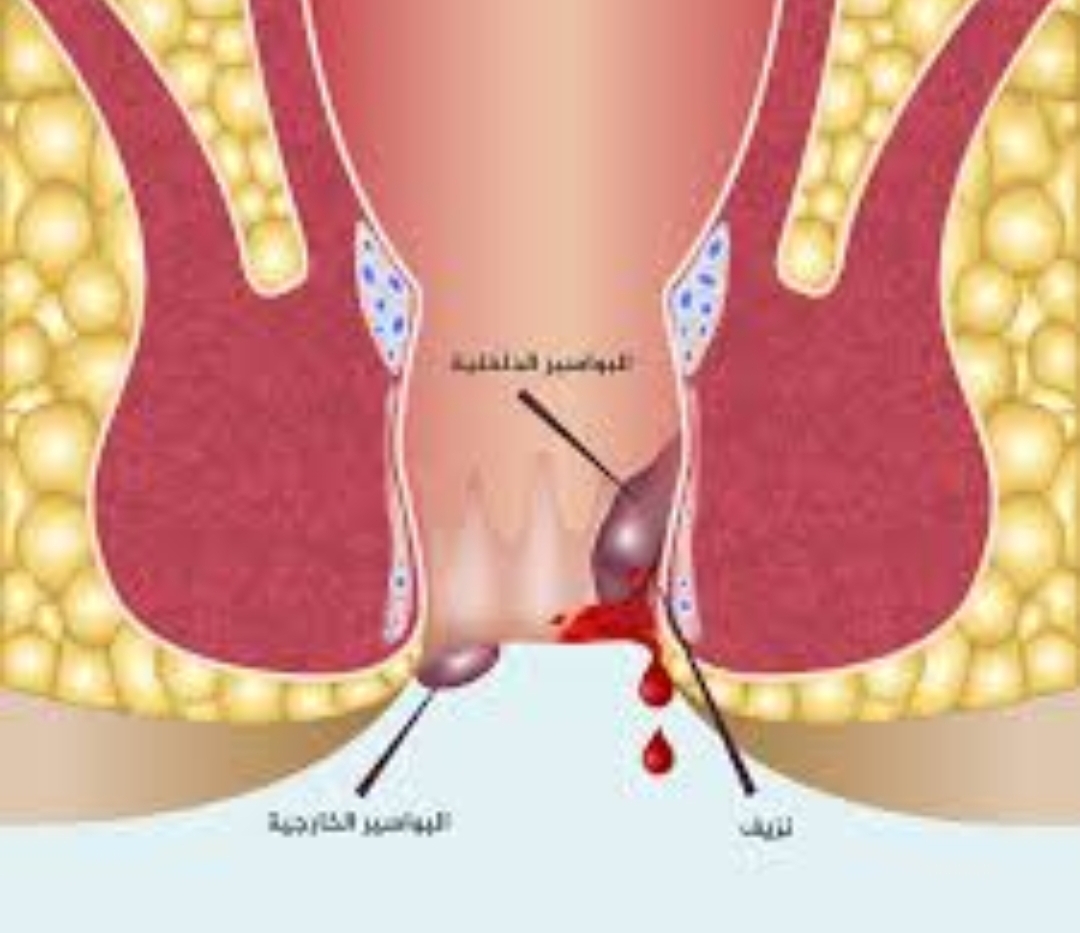  لتخلص من البواسير وبطرق طبيعية..تابعنا