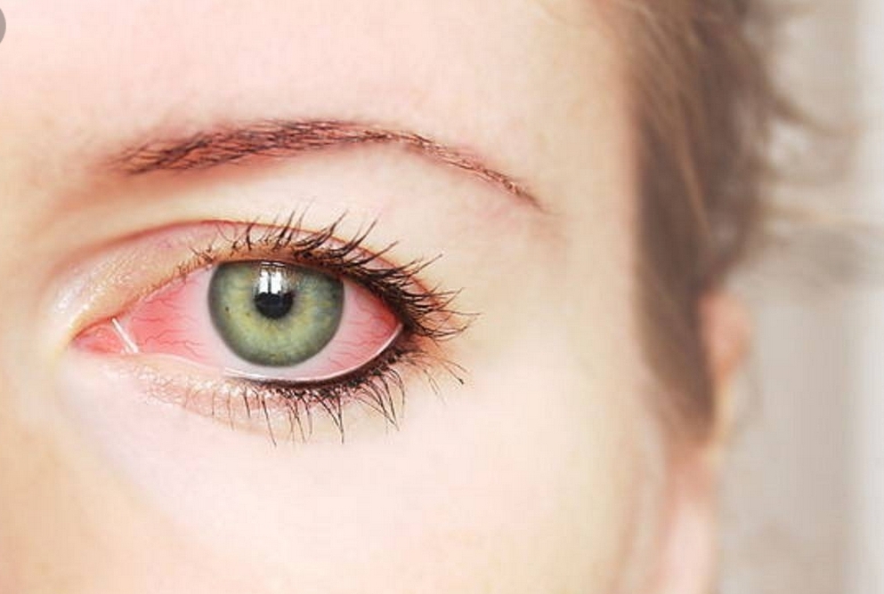  علاجات منزلية لتخلص من التهاب الملتحمة البكتيري العين
