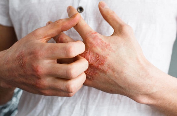  تعرف على أسباب وأعراض وعلاج إكزيما اليد