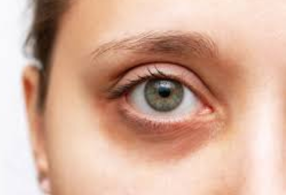  اكتشفي طريقة سهلة للتخلص من الهالات السوداء حول العينين