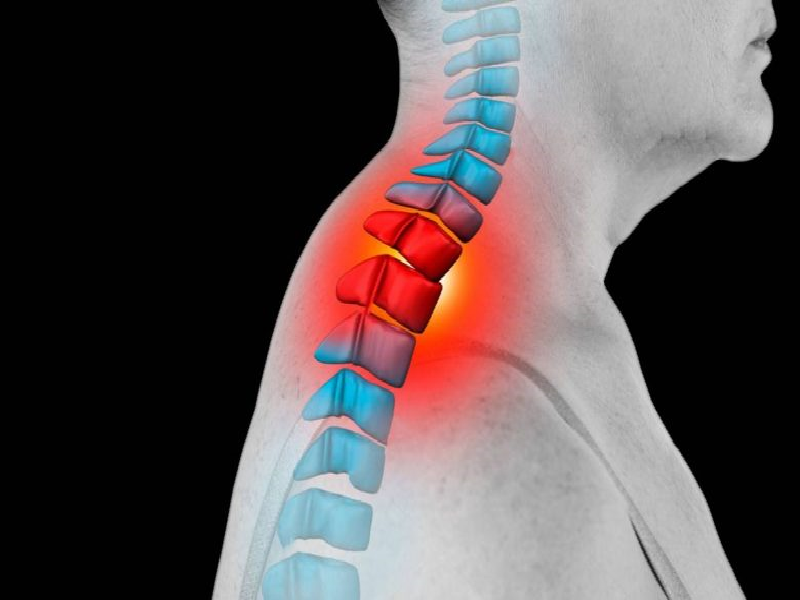 اسباب تقوس الرقبة وأعراضه وكيفية علاجه والوقاية منه