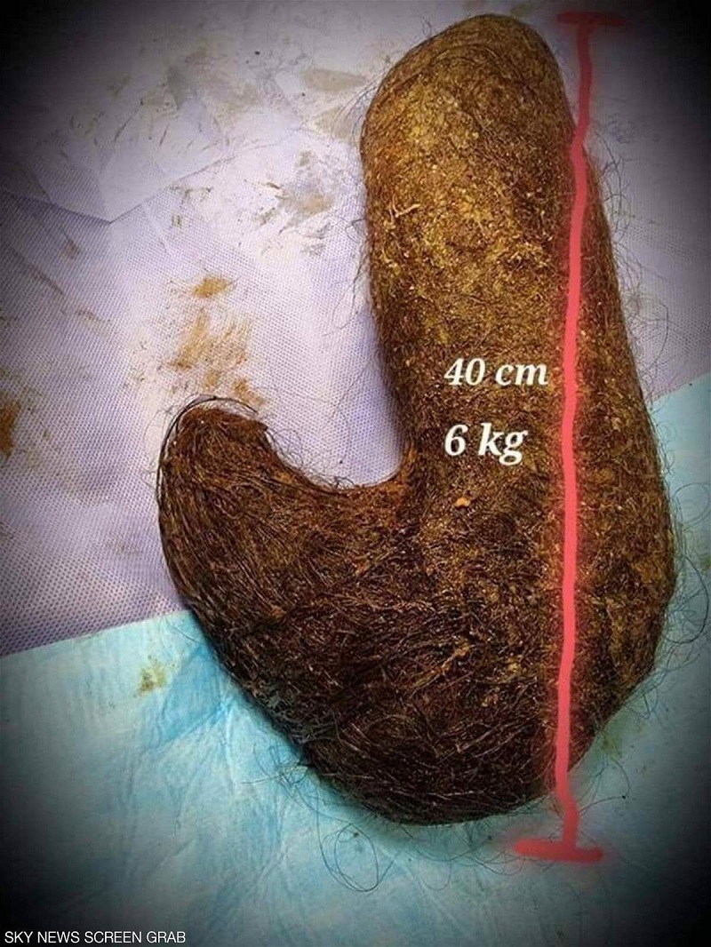 شاهد استخراج كتلة شعر وزنها 6 كيلو من بطن فتاة أردنية (صور)